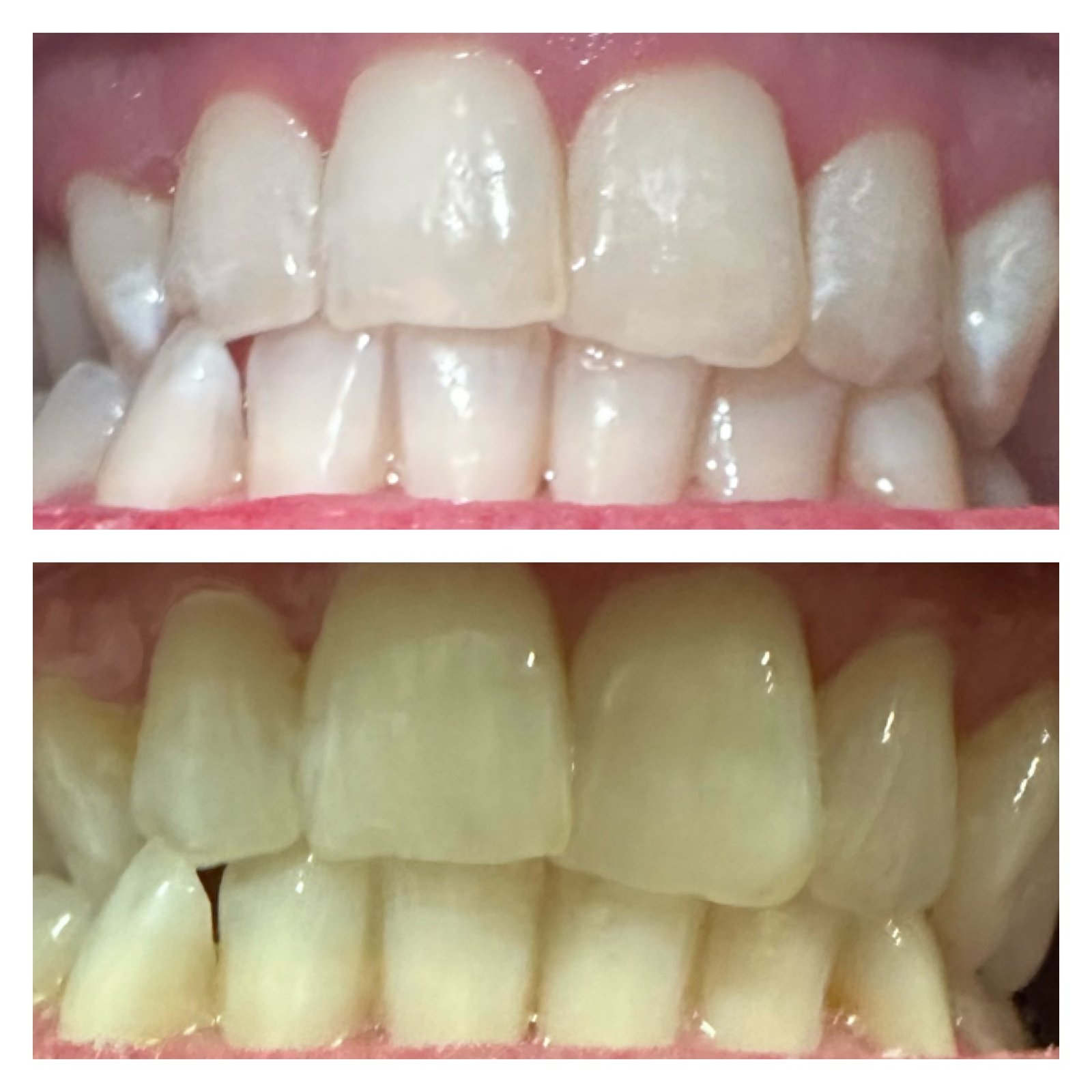 Teeth Whitening The Lounge North Idaho Med Spa