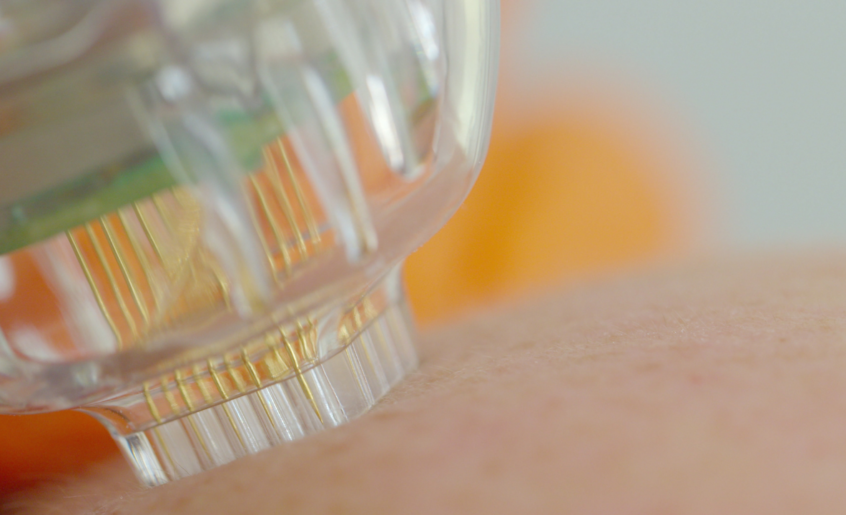 back fat microneedling treatment