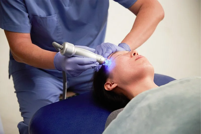 Scarlet RF microneedling treatment for skin tightening and rejuvenation at MedSpa North Idaho